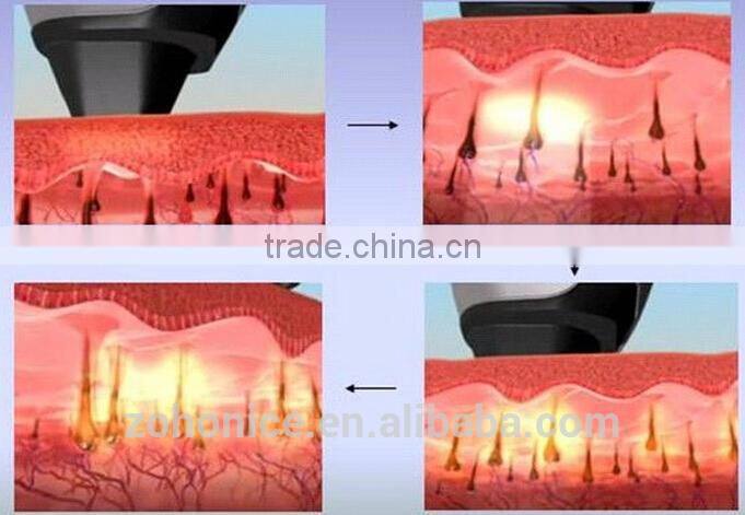 Y9C lumenis laser light 808nm diode laser hair removal