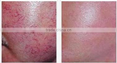 Vascular Removal machine