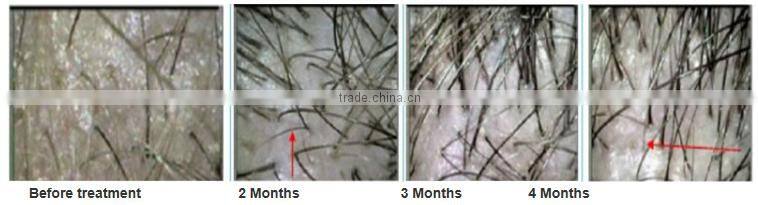 diode laser hair regrowth machine with the best price/laser hair growth helmet