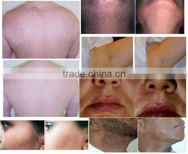 Hottest Germany device 808 diode / personal hair removal laser system