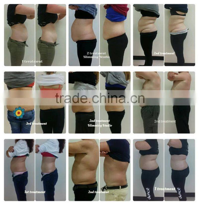 Portable Weight loss equipment slimming cryo fat freezing cryolipolysis machine for home use with 5 treatment handles