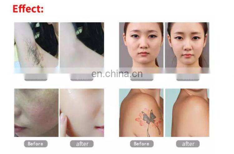 3 in 1 ipl dpl rf pico laser Tattoo Removal Skin Rejuvenation Pigment Removal SHR Elight Permanent Hair Removal