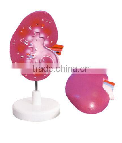 Kidney enlarge anatomy model