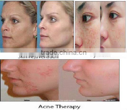 Zhengjia Medical LED PDT Skin Rejuvenation beauty Machine