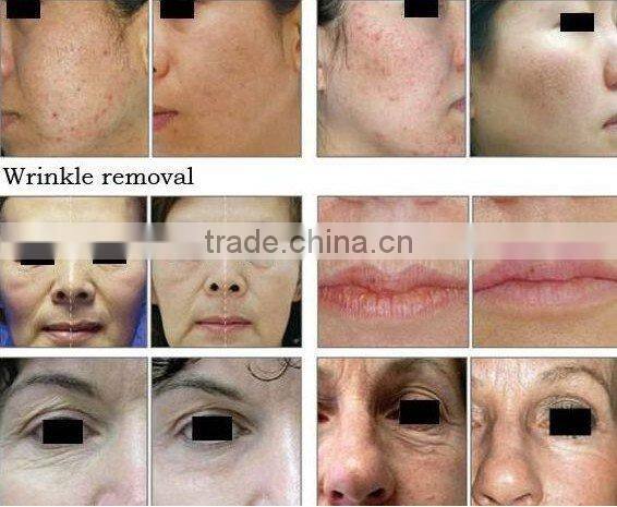 women lady nono lase hair removal machine epilator shaver for face and body home or salon use price C009 2013