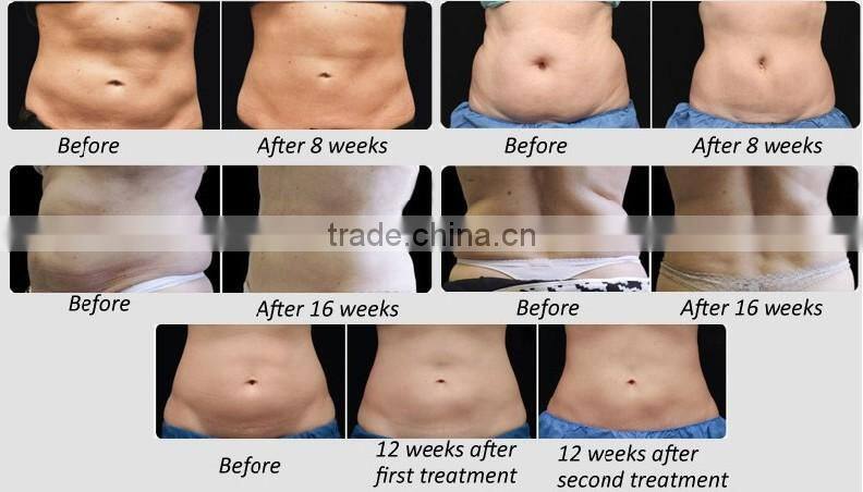 Hot promotion!!!!!2014 Newest Beauty Equipment Cryolipolysis Fat Reducing Machine