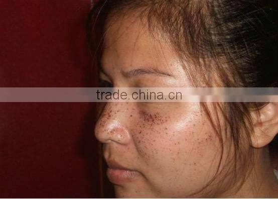 Muti-Function Beauty Equipment IPL SHR Laser