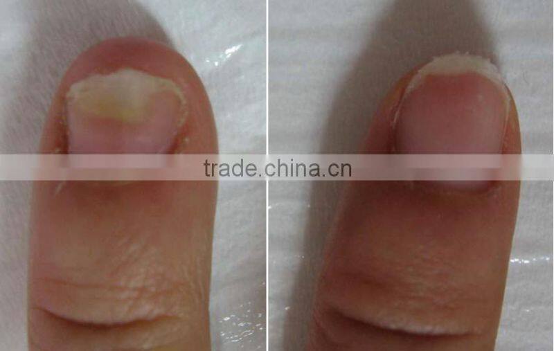 2014 long pulsed nd yag Laser hair removal machine/Laser depilator/laser blood vessels removal--P003