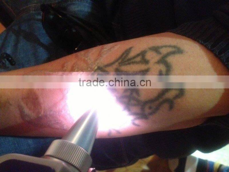 2016 Portable nd yag laser tattoo removal machine /laser tattoo removal equipment for spa/clinic/hospital