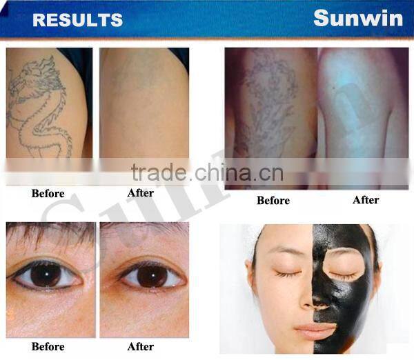 Sales Promotion!ND YAG Tattoo Laser beauty machine (SW-69E)