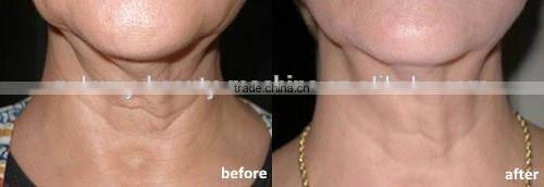 CET&RET RF face lifting multifunction rf