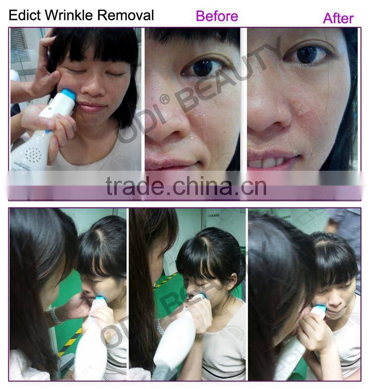 (CE Certificated) Non Surgical Mesotherapy Facial Firming Machine for Wrinkle Reduction&Fine Line Care R80