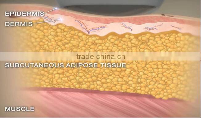 Hot new product hifu machine cryo hifu machine cryo liposunix for clinic use