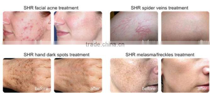 Portable Skin care SHR elight ipl hair removal machine