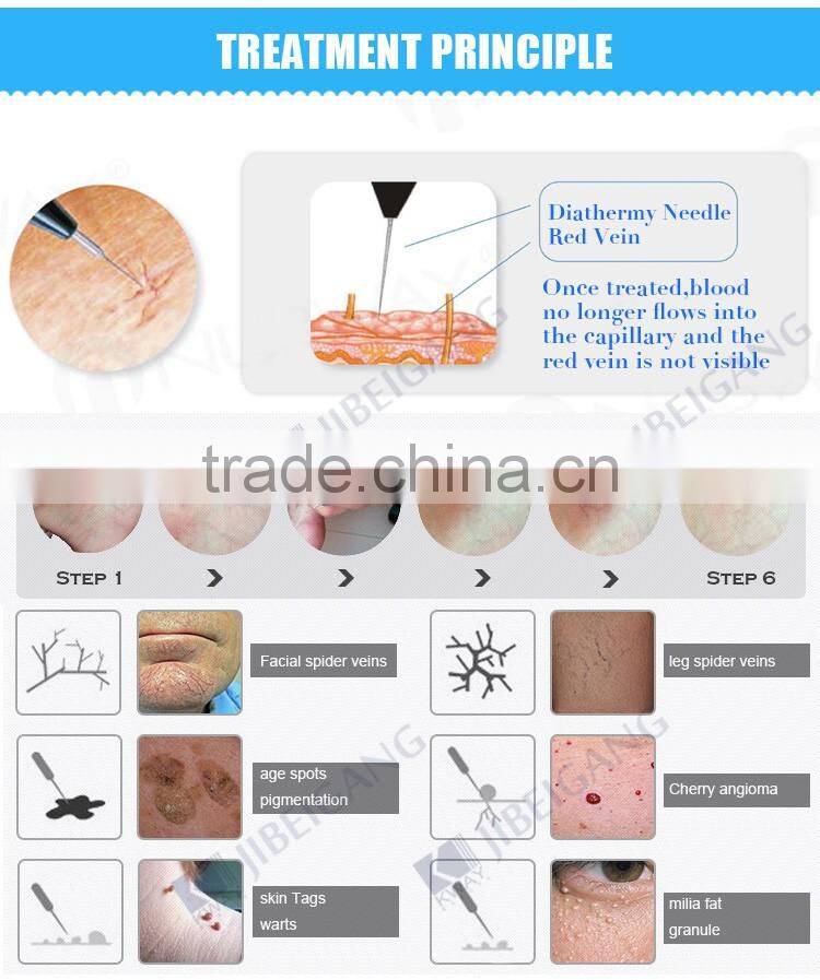 beauty salon use portable 30MHz RF laser blood vessels removal machine