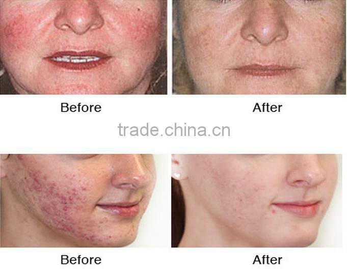 AYJ-X10 (CE)Newest Anti-age Facial Water Dermabrasion Spray Machine