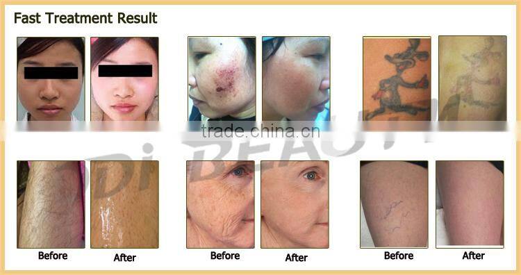 Cheap Laser, RF, IPL 3 in1 multifunctional beauty equipment OD-IRL20