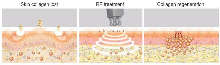 5 in 1 lost weight explosive speed grease cavitation slimming system