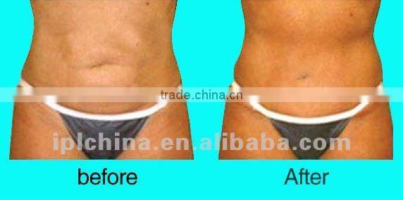 Potable Ultrasonic Slimming Machine Liposuction