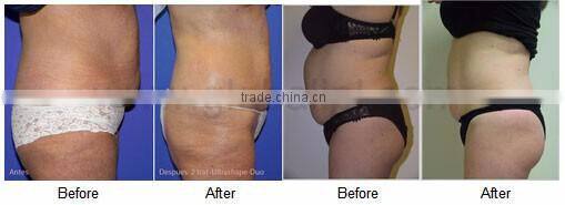 Vertical body slimming ultrashape cavitation beauty machine