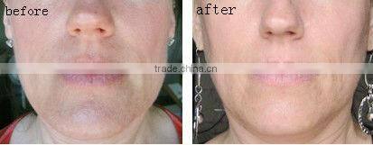 Good price skin care anti-wrinkle cold hammer facial massage beauty equipment