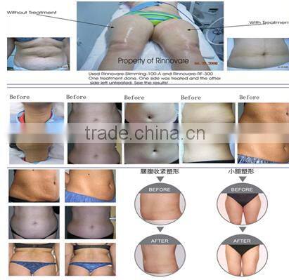 Body Shaping Radiofrequency Machine