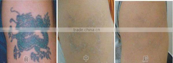 Cheap Price Mini Q switch nd yag laser tattoo removal Machine D001