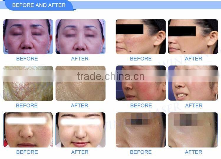 Competitive price 5 bottles secret skin repair liquid spider veins removal machine for age spots