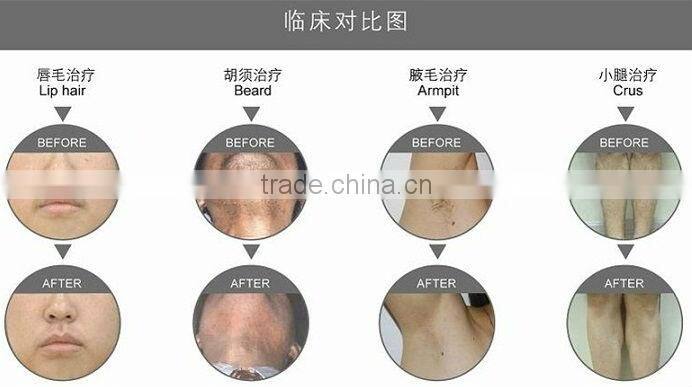 ND Yag Brown Hair Removal Physiotherapy Device