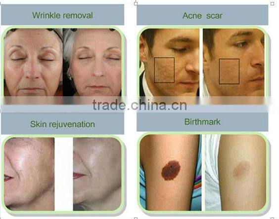 stationary vaginal tighten beauty machine/scar removal fractional co2 laser