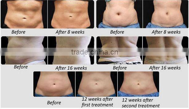 CE approved ultrasound cavitation slimming machine