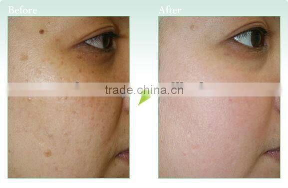 Hot!! Newest and best effective Beauty salon equiment for skin rejuvenation