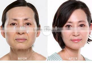 Radio frequency and mesotherapy machine for skin lifting and tightening