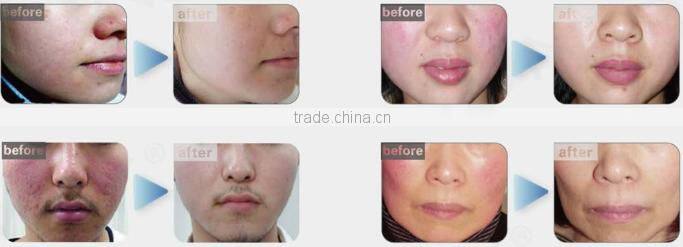 2016 30M HZ High Frequency RBS100 Spider Vein Removal machine / Vascular Removal Machine