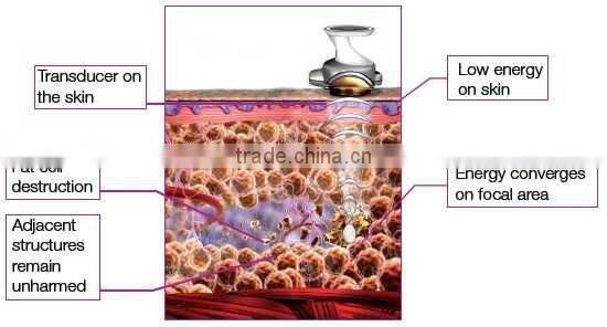 ultrasonic liposuction cavitation slimming machine for sale