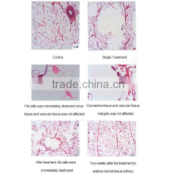 High Grade Liposonix!!! Fat Reduction Machine/Liposonix Machine with FDA