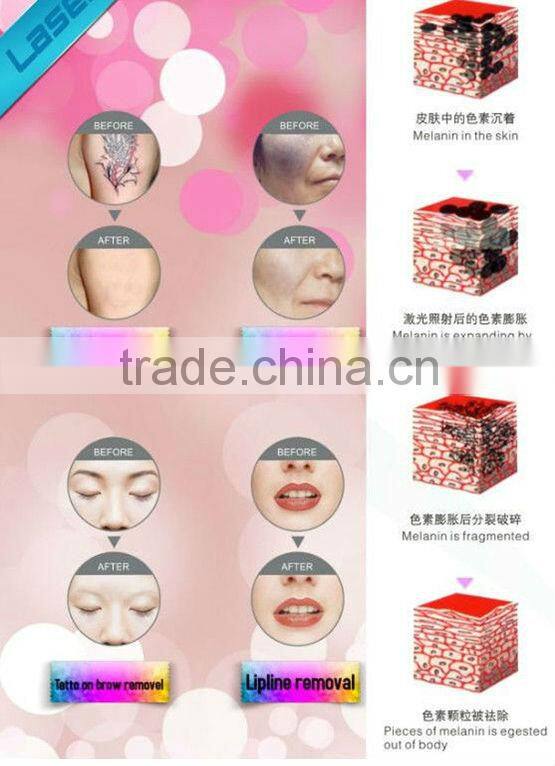 Professional laser hair and tattoo removal machine with best price