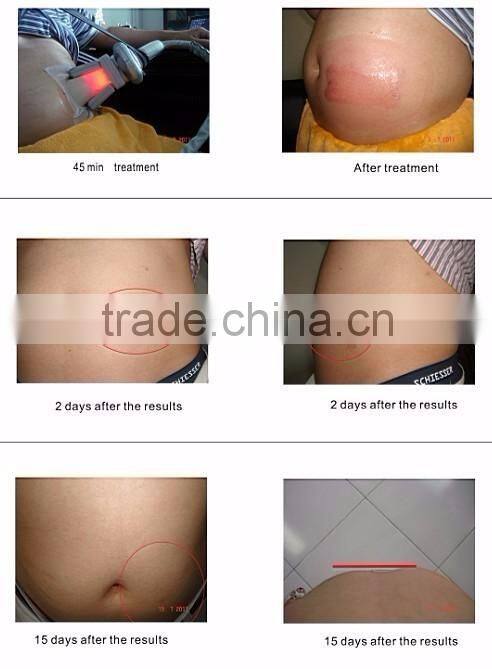 Professional cryolipolysis device/portable cryolipolysis machine price/Cavitation slimming machine