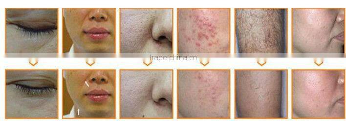 Portable professional IPL hair removal machine distributors wanted