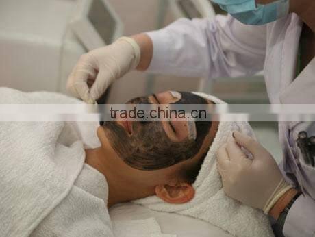 Distributors wanted best selling products Laser Tattoo Removal / pigmentation removal q switch nd yag laser Machine for sale