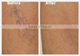 factory price best beauty device / facial veins removal / laser varicose veins treatment