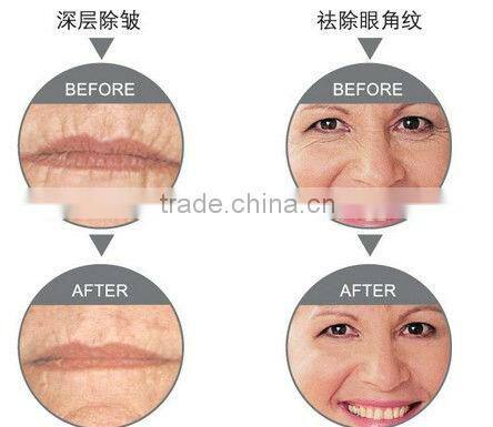 Portable professional IPL hair removal machine distributors wanted