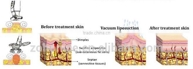 BD08 New slimming cryo fat freezing cryolipolysis slimming machine