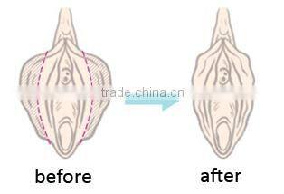 CO2 fractional laser vaginal tightening/laser vaginal rejuvenation equipment