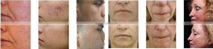 2016 High Quality Non-invasive 40.68mhz radio frequency treatment for sagging skin