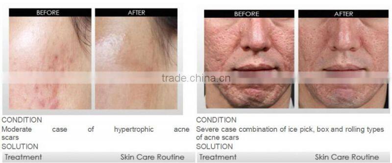 540 derma roller