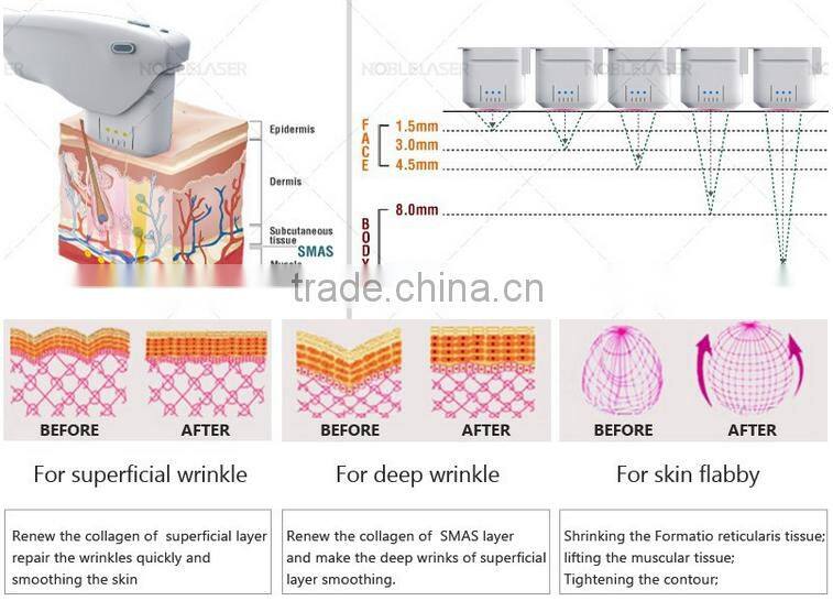 Non-surgical no-wound hifu anti-aging face lift machine with 3 cartridge different treatment