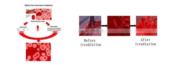 popular nasal cavity laser irradiation rehabilitation diabetes treatment equipment blood circulation improver