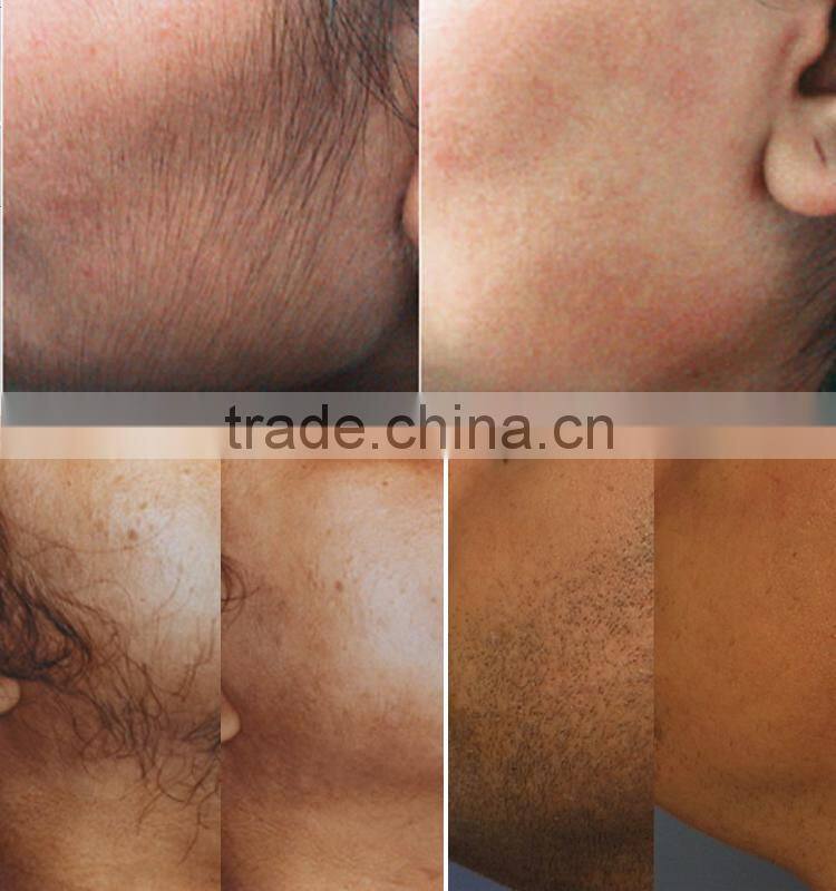 2015 IPL elight hair removal machine ,powerful energy