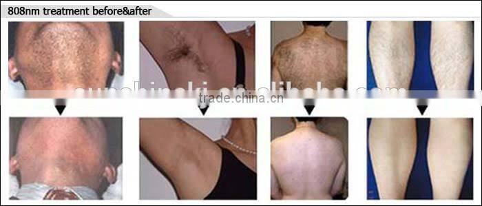 Big discount TEC cooling system 10 laser bars stationary 808nm diode laser wholesale laser hair removal machine